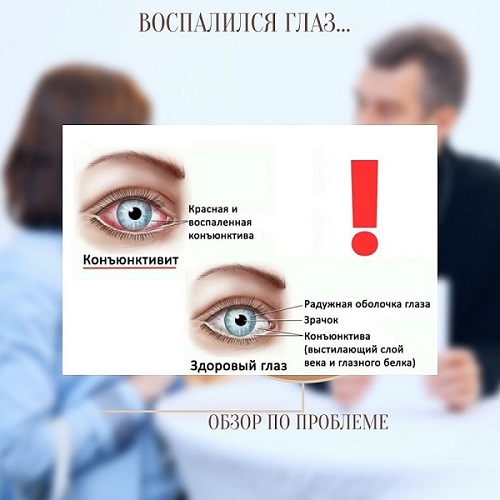 Воспаление слизистой оболочки глаза 